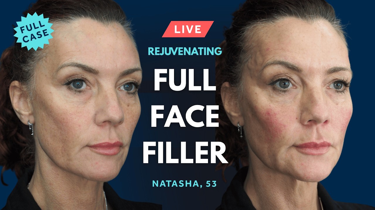 LIVE Multi-Area Filler Treatments 💎 GEM© Clinic Facial Rejuvenation inc. Temple & Midface Fillers