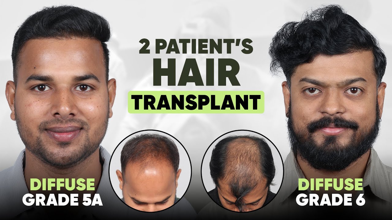 Best Hair Transplant in Hazaribagh (HX-CDSR) | Best Results & Cost of Hair Transplant in Hazaribagh.