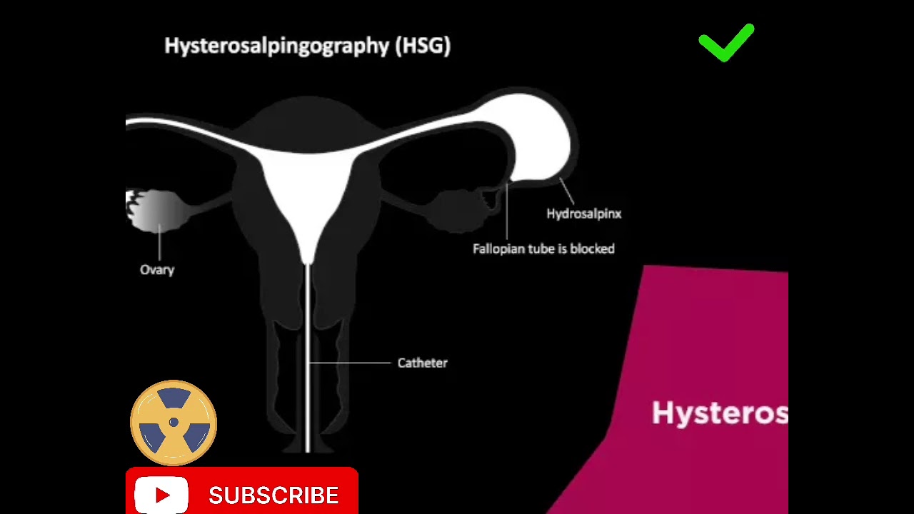 X - RAY PROCEDURE HSG 
