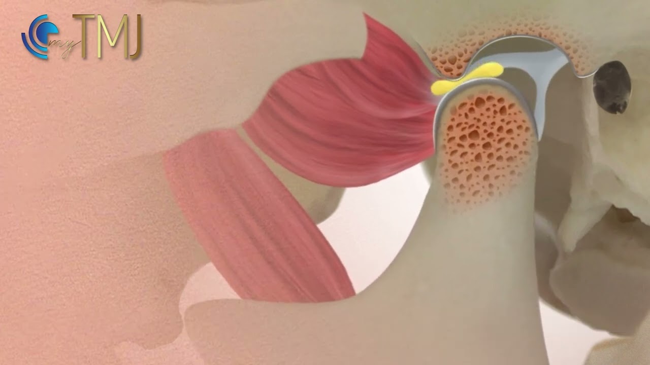 Jaw clicking  (disc displacement with reduction)