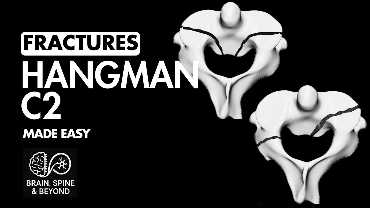 C2 Hangman Fracture Everything You Need to Know: Mechanism, Classification, imaging and Treatment