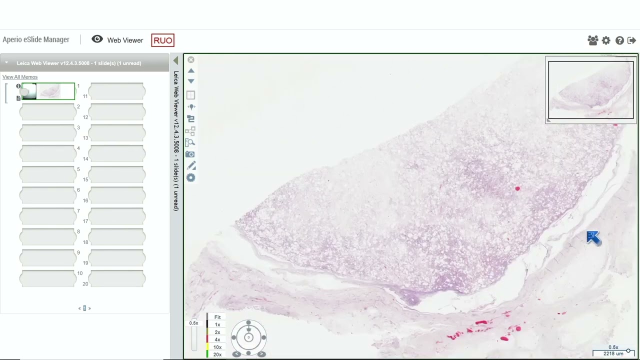 A Pattern-Based Approach to Soft Tissue Tumors, Part 1 by John R. Goldblum, M.D.
