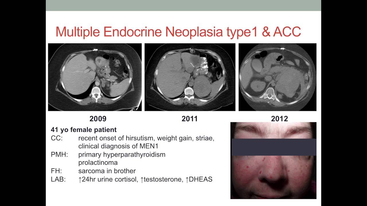 Symposium 16, Pathogenesis of adrenocortical tumours: Tobias Else
