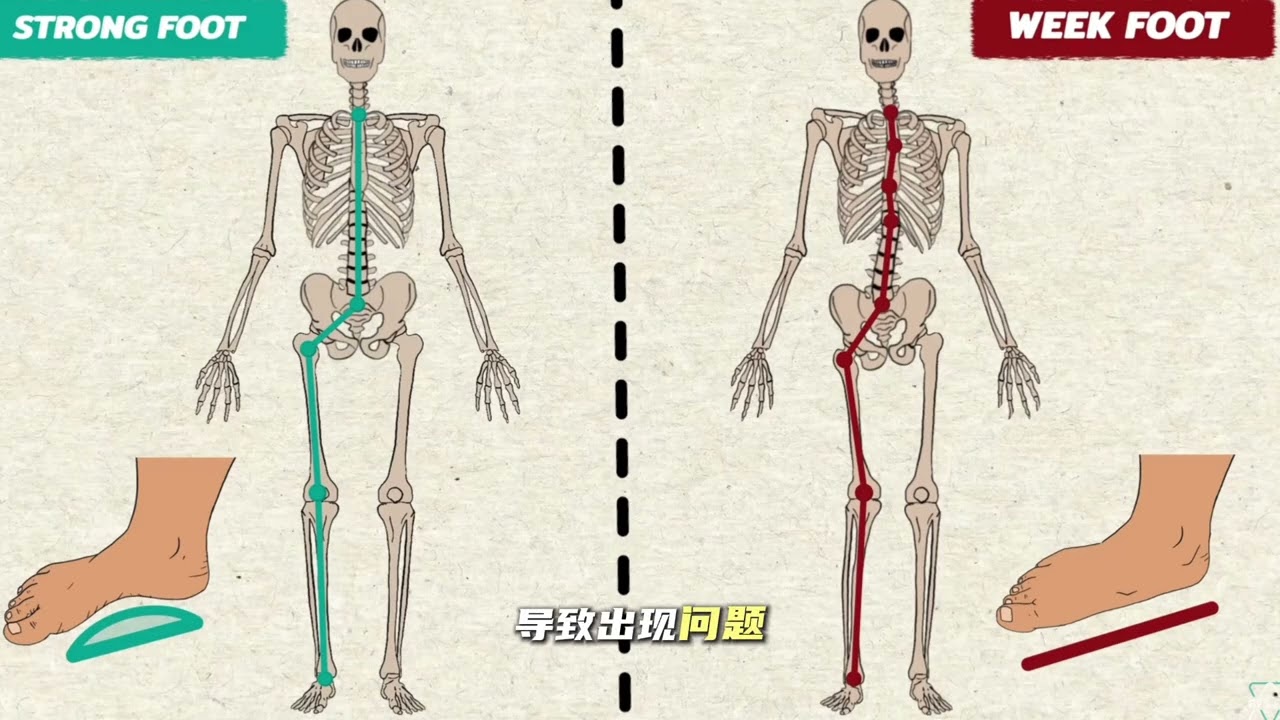 足底筋膜炎｜正确的康复方案
