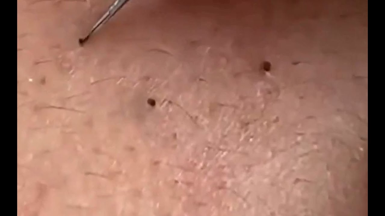 #4 Blackhead Removal  \ Удаление черных точек