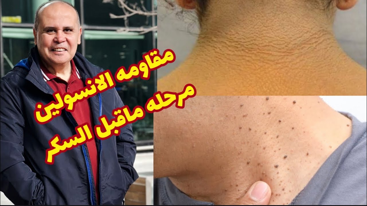 اعراض وعلامات في جسمك  تخبرك انك عندك مقاومه الانسولين👈السكر التراكمي 👈مرحله ماقبل السكري