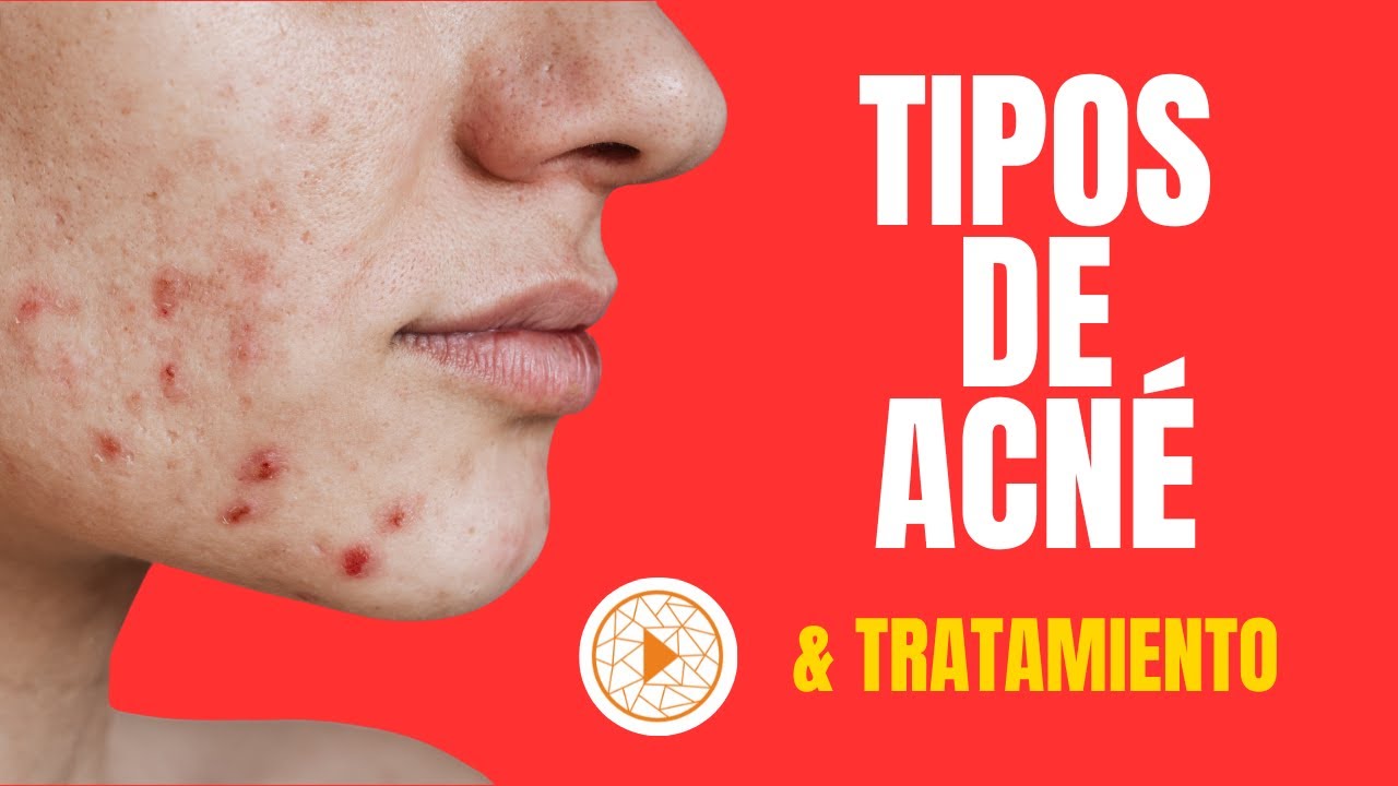 ¿QUÉ TIPO DE ACNE TIENES?| La identificación y el tratamiento habitual de los tipos de acné