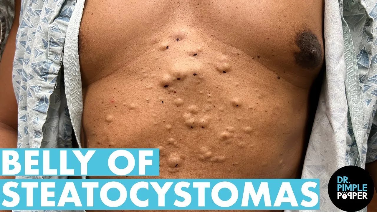 STEATOCYSTOMA OVERLOAD on the Belly! | Dr. Pimple Popper