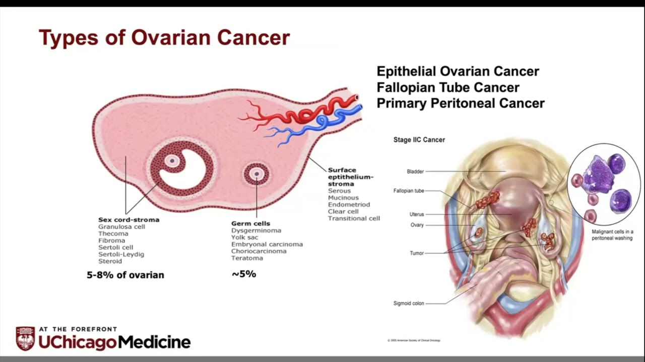GYN Cancer 101 Webinar -- 9.17.25