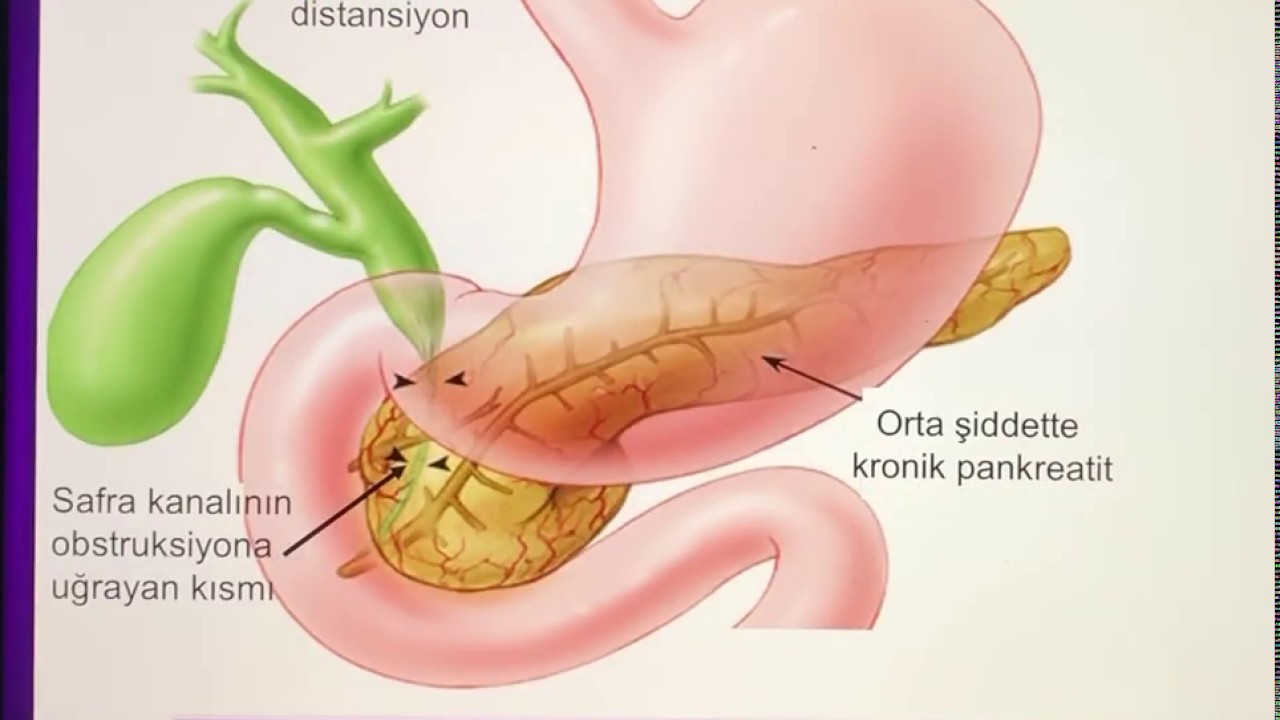 Kronik Pankreatit