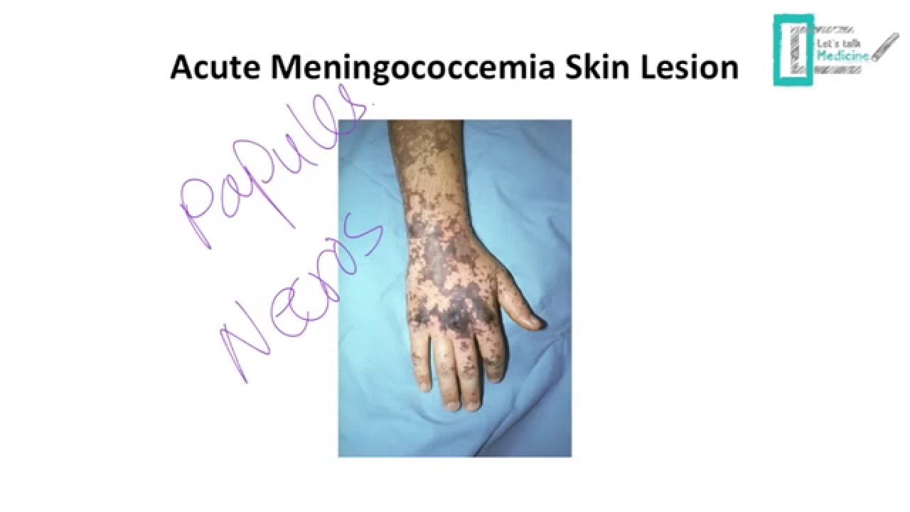 Septic Arthritis