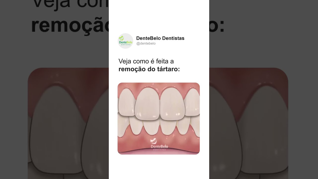 Veja como &eacute; feita remo&ccedil;&atilde;o do t&aacute;rtaro | DenteBelo