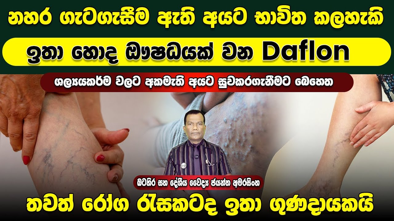 නහර ගැට ගැසීම තිබෙන අයට භාවිත කල හැකි හොද ඖෂධයක් මෙන්ම තවත් රෝග වලට ඉතා ගුණ Daflon ගැන සවිස්තරව