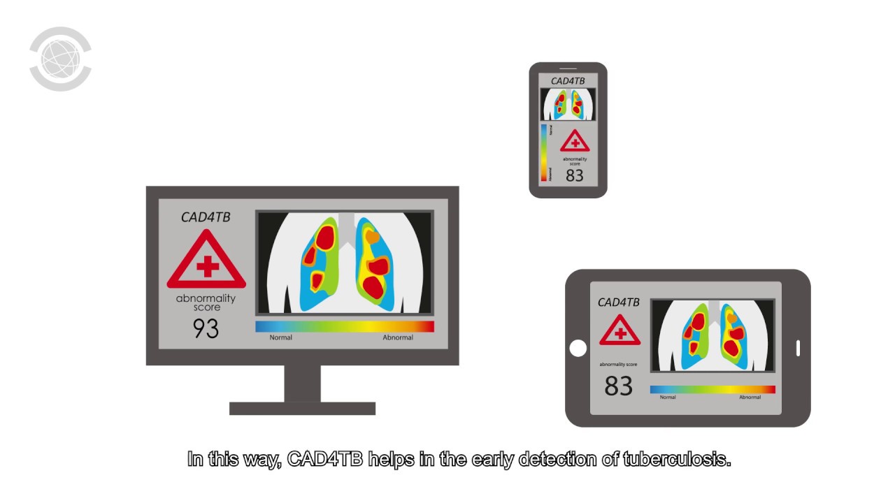 Delft Computer-Aided Detection for Tuberculosis (CAD4TB) box & cloud