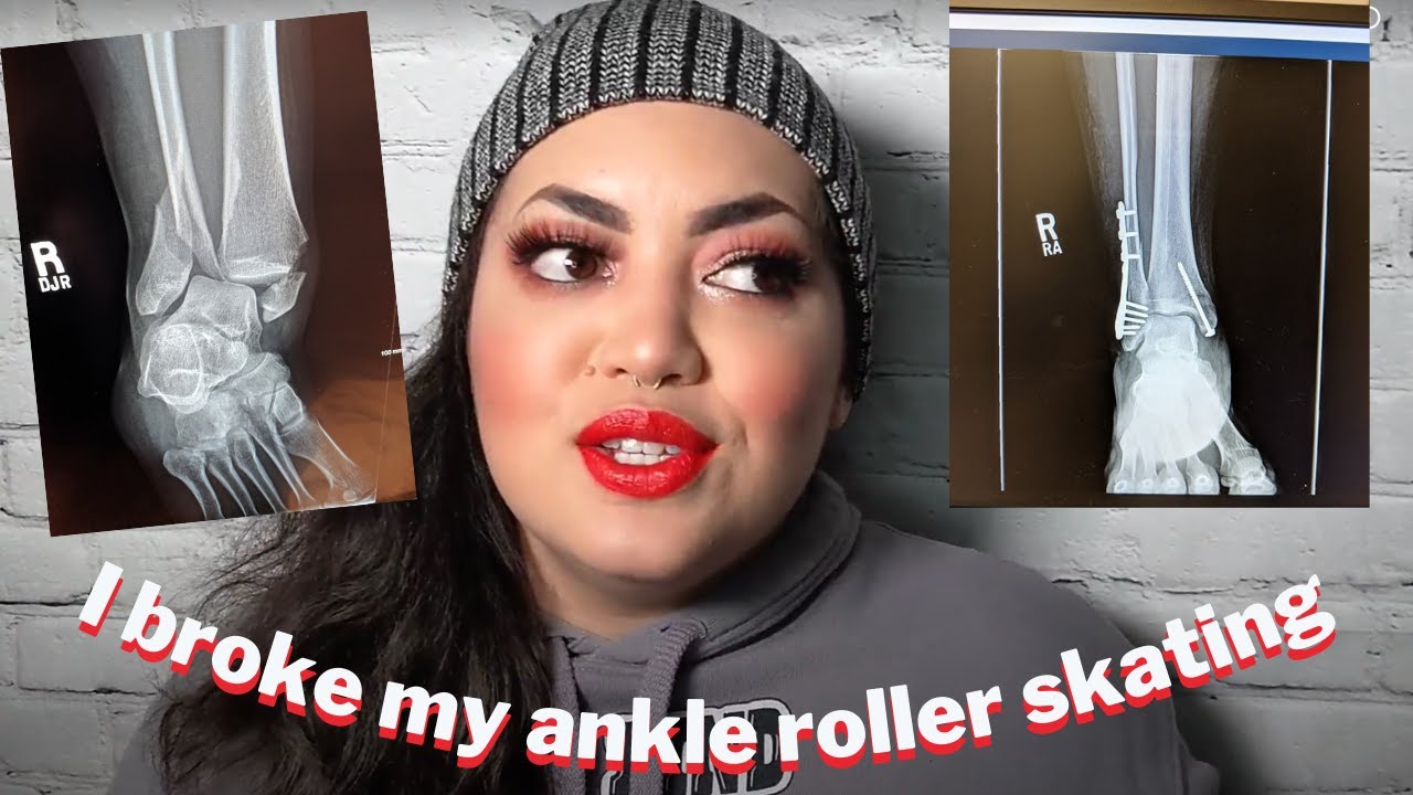 I Broke My Ankle at the skate park | My Story & Recovery