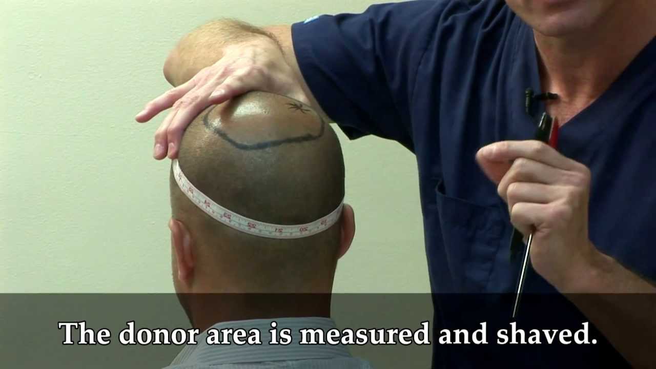 Dr. Brett Bolton Hair Transplant Surgery