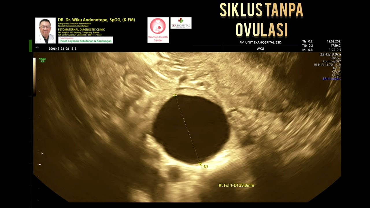 Siklus anovulasi
