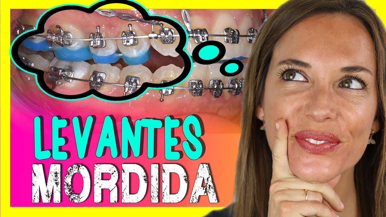 🛑𝑻𝑶𝑷𝑬𝑺 𝑫𝑬 𝑹𝑬𝑺𝑰𝑵𝑨 para levantar MORDIDA🛑Que son los LEVANTES DE MORIDA en ortodoncia con BRACKETS