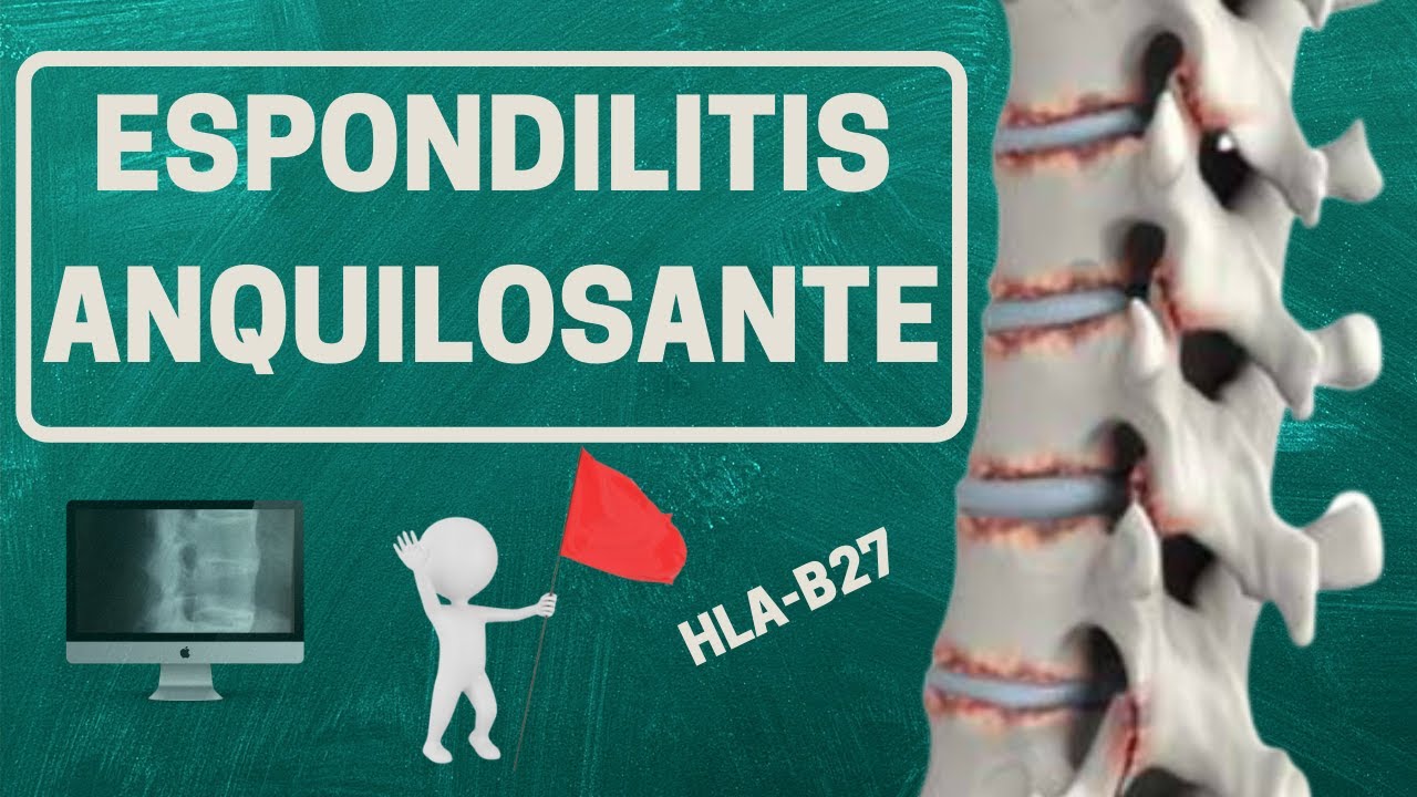 ESPONDILITIS ANQUILOSANTE &iquest;Qu&eacute; es realmente?