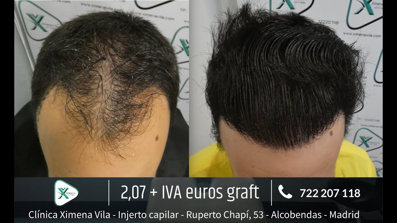 Trasplante capilar FUE - Hair transplant - Dra. Ximena Vila - 3555 Grafts