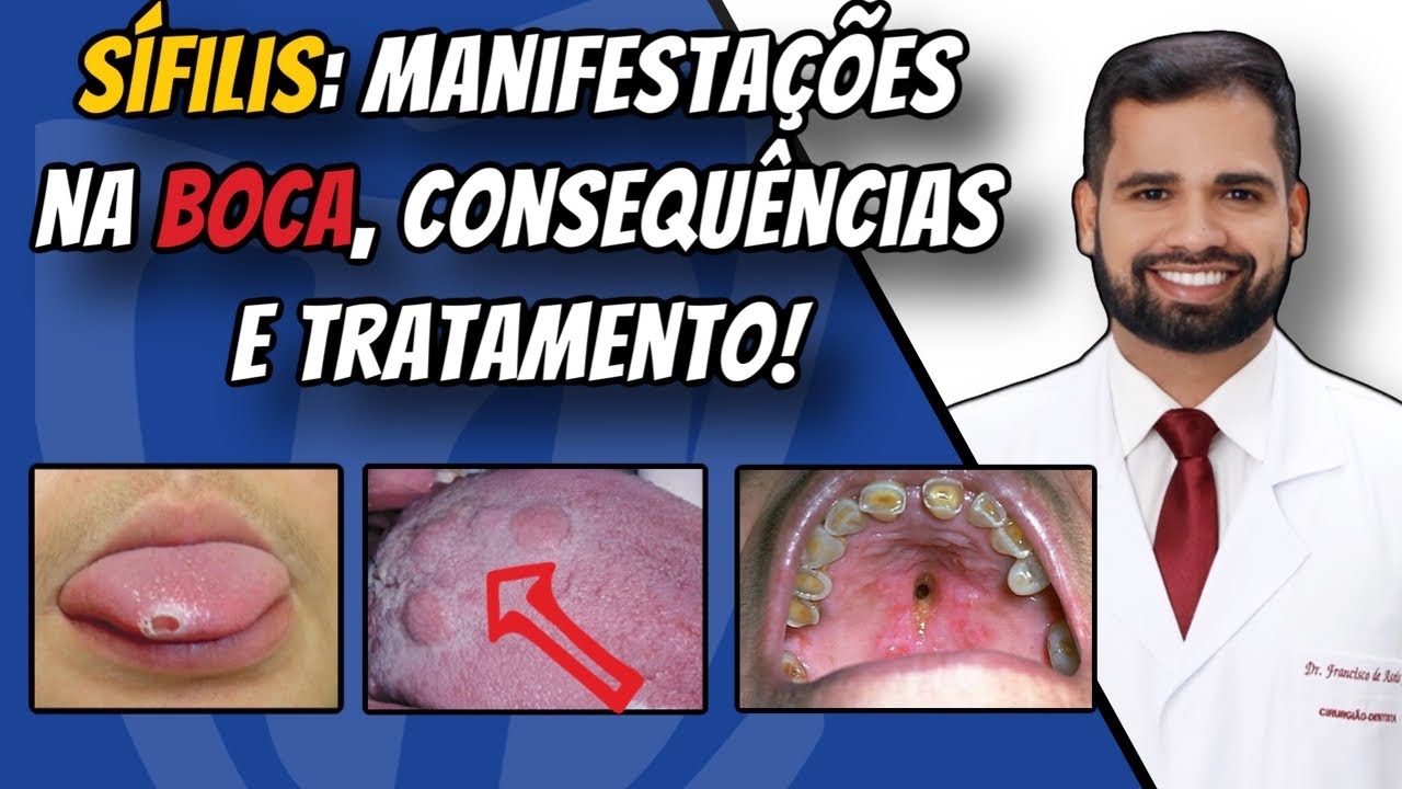 Sífilis: Manifestações na boca, consequências e tratamento! #sifilis #boca #infecção