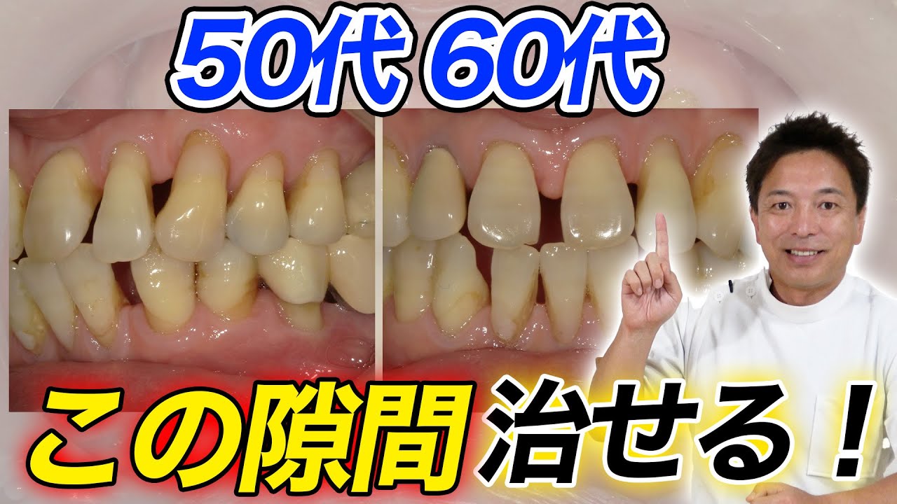 【ブラックトライアングル】【すきっ歯】は神経を残すセラミック矯正でこんなに綺麗に！