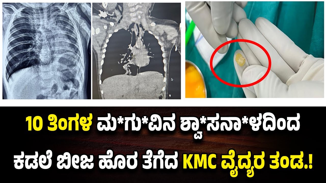 10 ತಿಂಗಳ ಮ*ಗು*ವಿ*ನ ಶ್ವಾ*ಸನಾ*ಳದಲ್ಲಿ ಕಡಲೆ ಬೀಜ ಸಿ*ಲು*ಕಿ ಸಮಸ್ಯೆ..ಮಂಗಳೂರಿನ KMC ವೈದ್ಯರ ಯಶಸ್ವೀ ಕಾರ್ಯಾಚರಣೆ.!