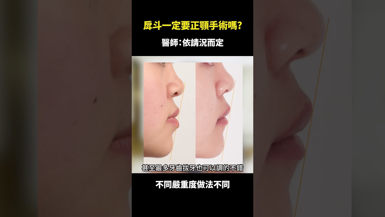 戽斗矯正不開刀可以嗎？