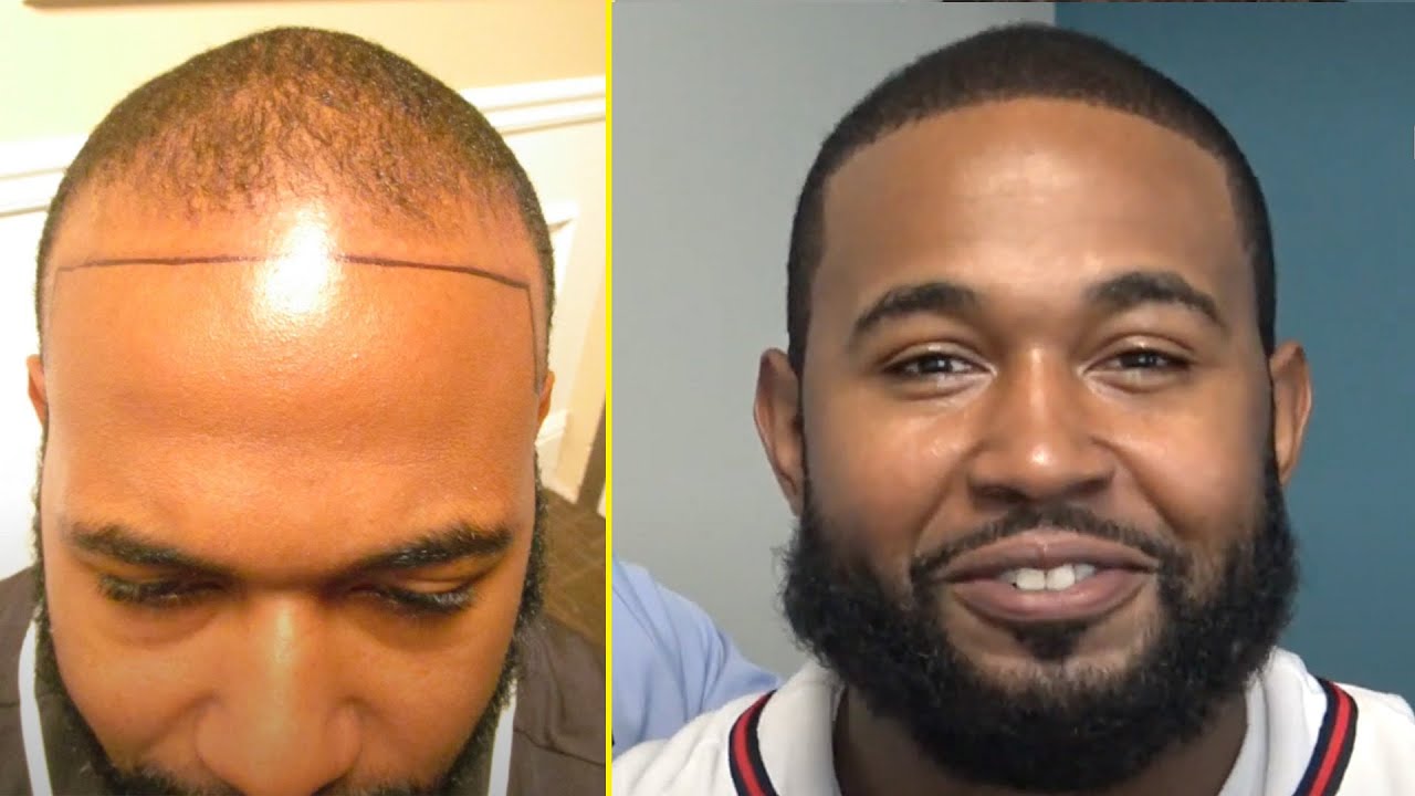 FUE Frontal Hairline Reconstruction at Hair Restoration Specialists of Atlanta
