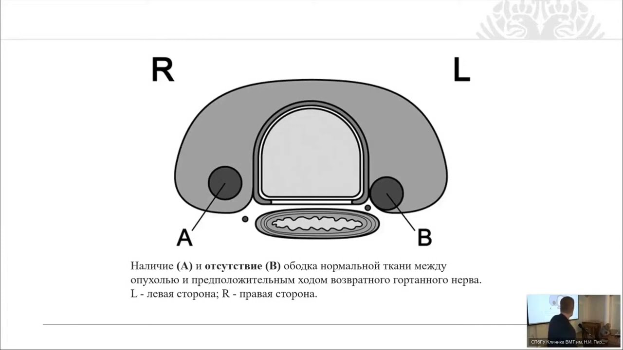 Папиллярная микрокарцинома щитовидной железы – тактика лечения