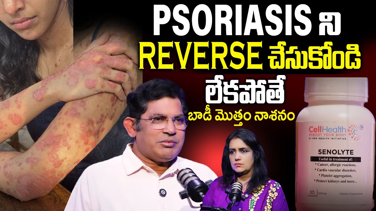 🤯💀 SCARYYY! Dr Chinta Ravi Kumar Revealed Shocking Truth about Psoriasis | SumanTv Doctors