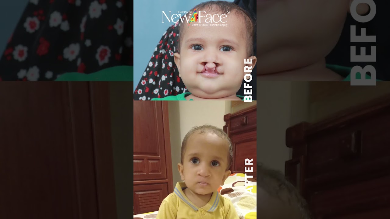 3 Month Result After Cleft Lip Surgery in India | Best Cleft Lip Surgeon in India - Dr Mathew PC