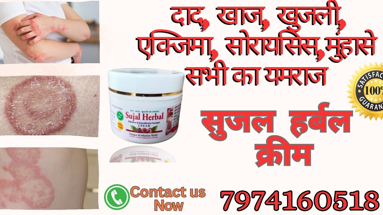 sujal Herbal antiFungal cream | antiFungal cream for fungal infection | daad khaj khujali ki dawa