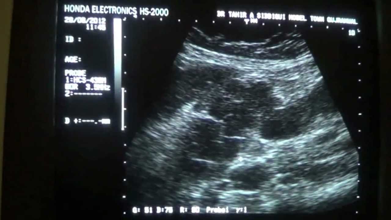 para-aortic plain adenopathy of benign cause