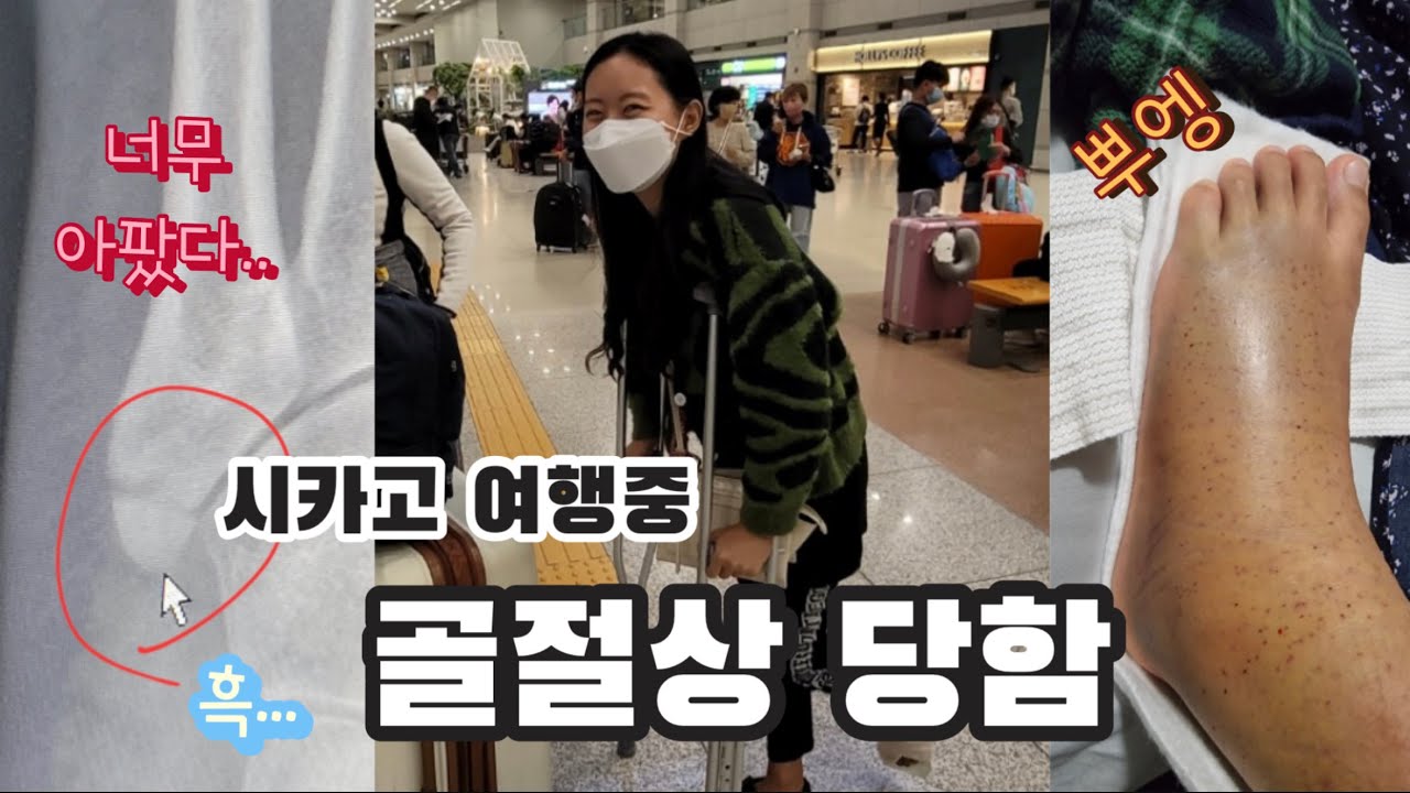 Eng) 미국 교환학생 중 시카고 여행 갔다가 발 부러짐 (중족골 골절) | 거지같은 미국 병원