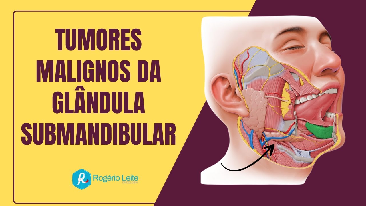 Tumores Malignos da Glândula Submandibular: Diagnóstico e Tratamento que Você Precisa saber