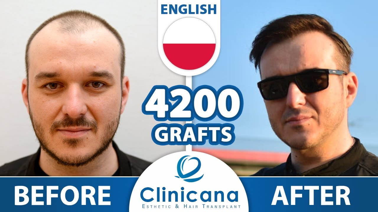 The result of the hair transplant was achieved by Mr. Adam at the Clinicana in Istanbul