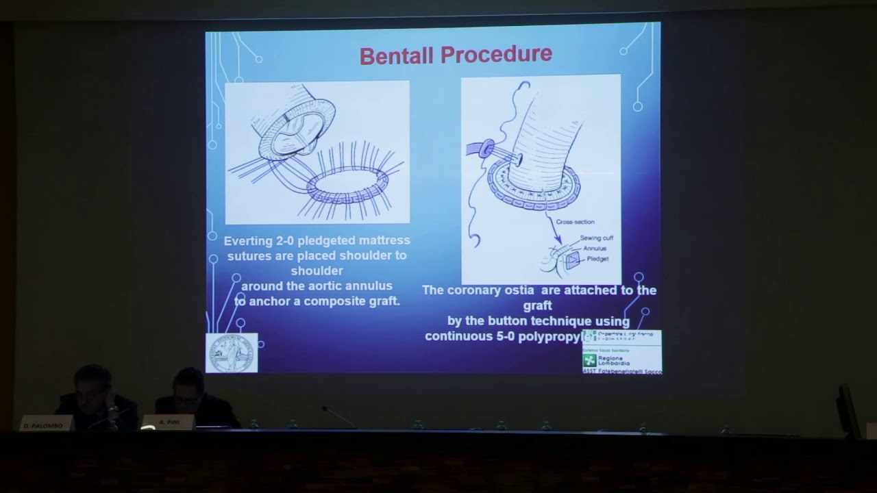 18.  Type A Aortic Dissection by Prof Carlo Antona