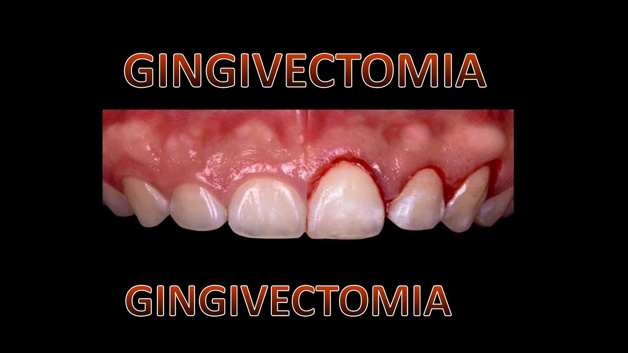 GINGIVECTOMIA!!ALARGAMIENTO DE CORONA!!!! ALARGAMIENTO CORONAL 1/2