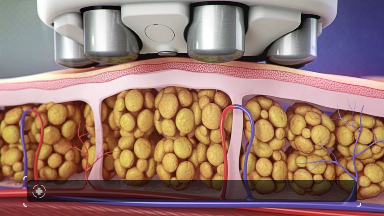 Venus Legacy™: An Advanced Solution for Challenging Aesthetics