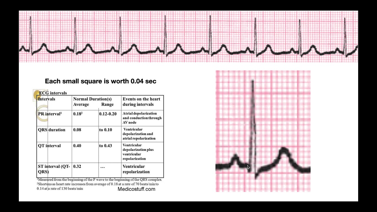 How to Determine Intervals & Segments on EKG EXPLAINED