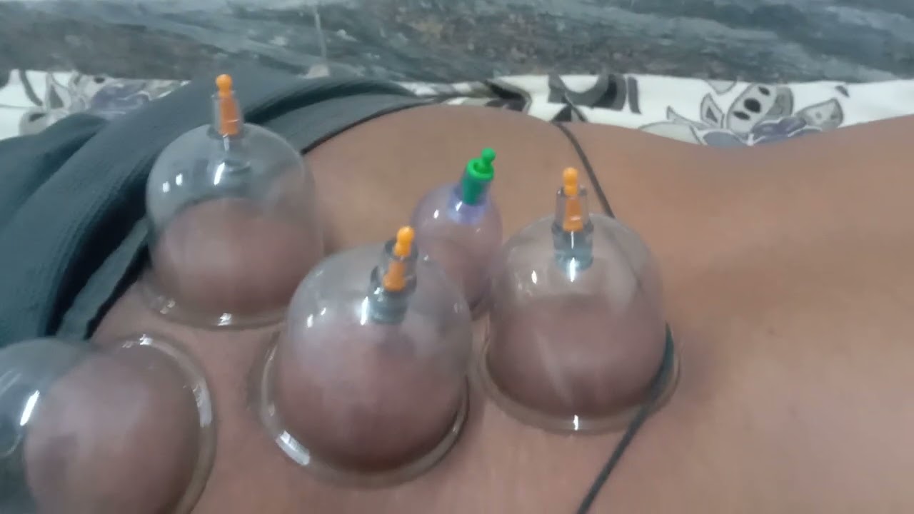 Cupping therapy treatment for sciatica and back pain 
