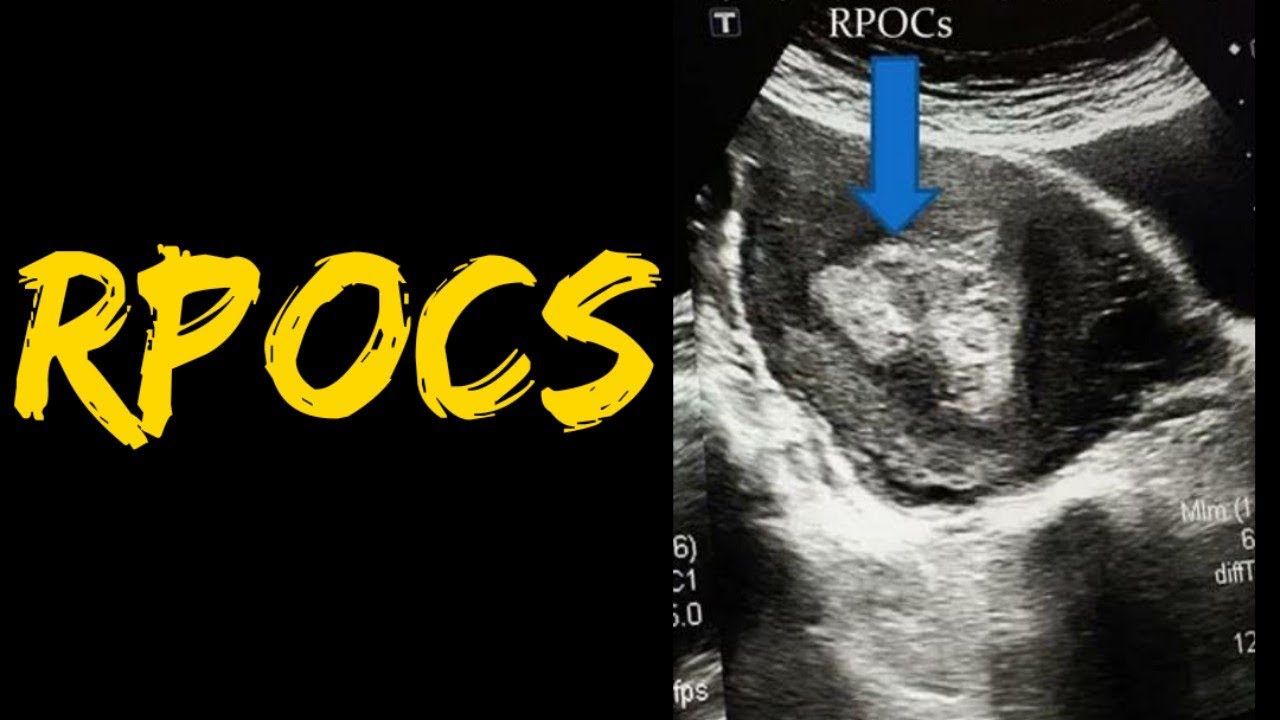 Retained Products of Conception | RPOCs on Ultrasound