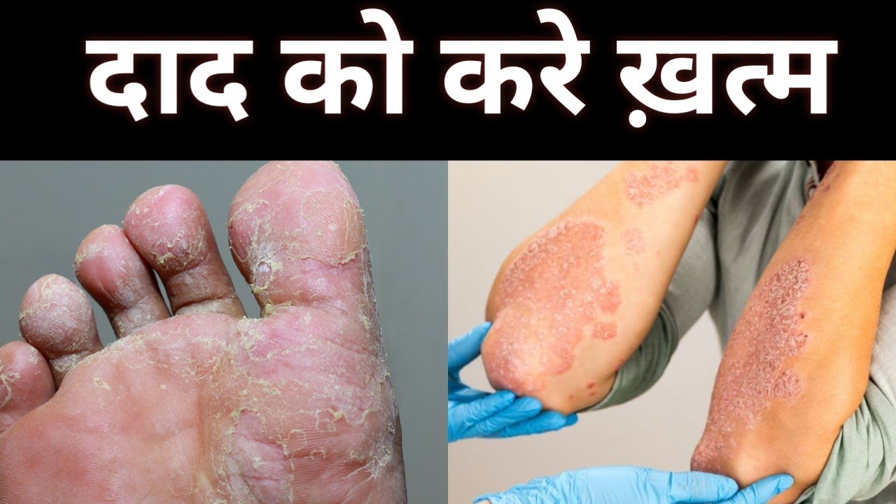 daad khaaj khujli ki dawa | dermiford cream | use dose & side effects