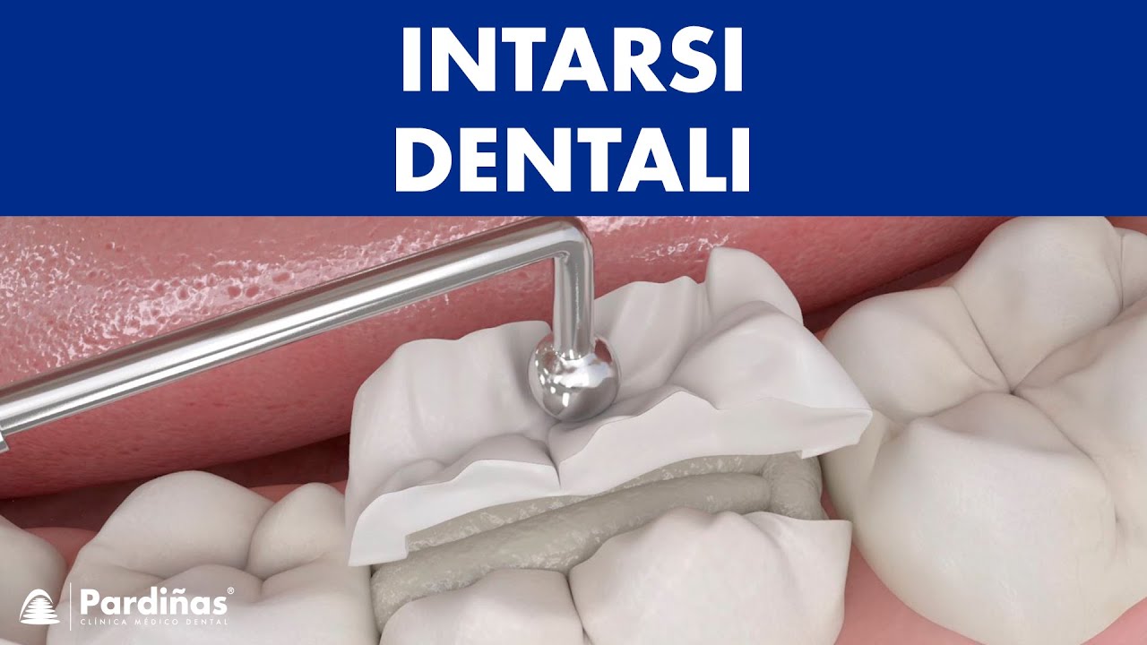 Intarsi dentali ©