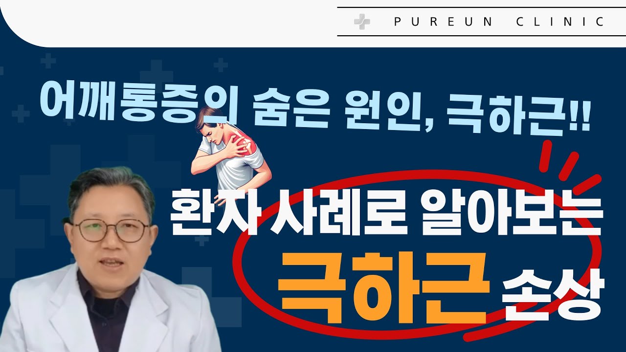 어깨 통증의 숨은 원인, 극하근! 환자 사례로 알아보는 극하근 손상