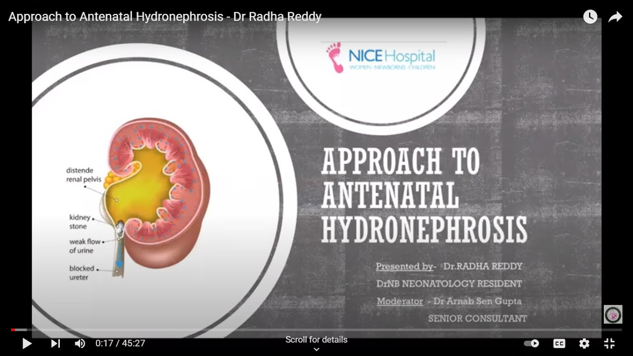 Approach to Antenatal Hydronephrosis - Dr Radha Reddy