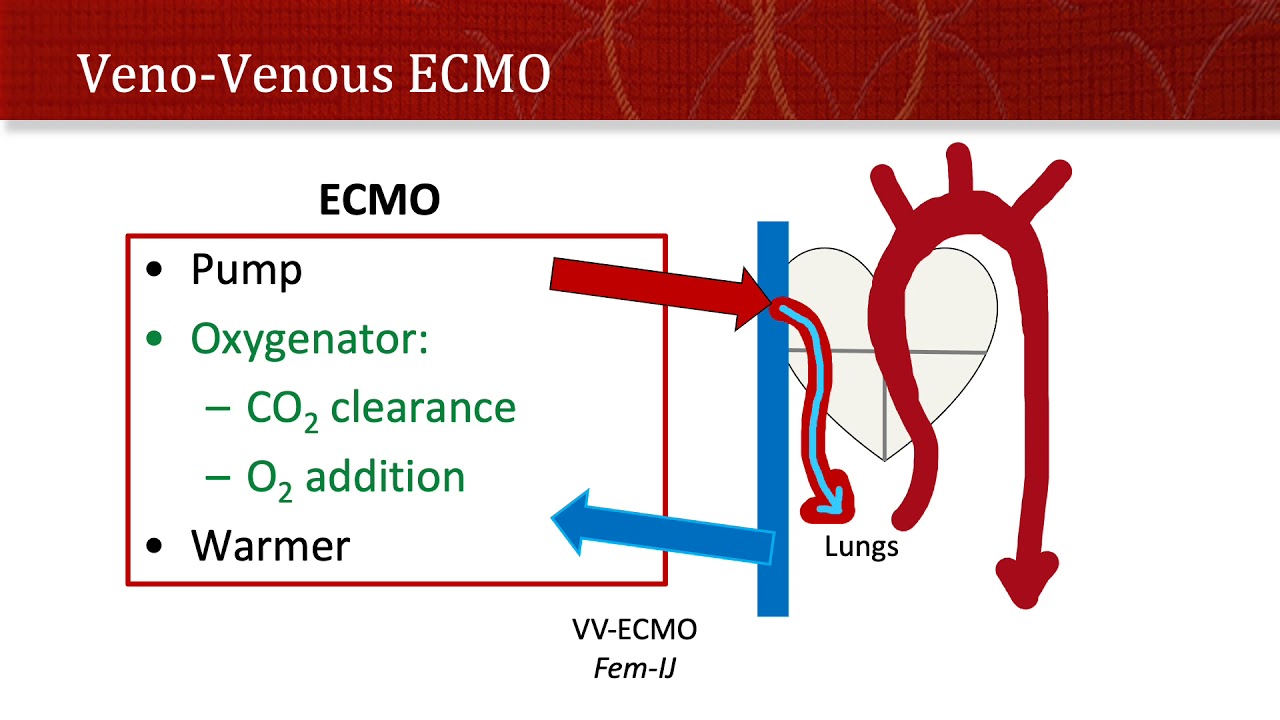 Thinking Simple - ECMO!