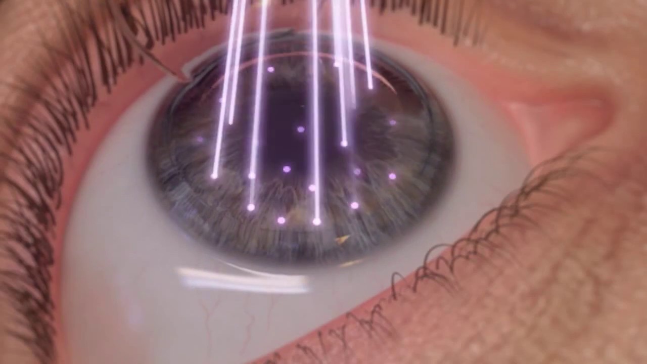 Cirug&iacute;a refractiva con l&aacute;ser de femtosegundo