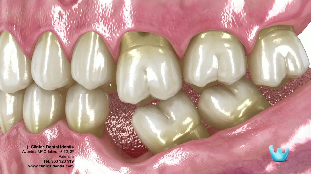 Alteraciones bucales tras la pérdida de un diente